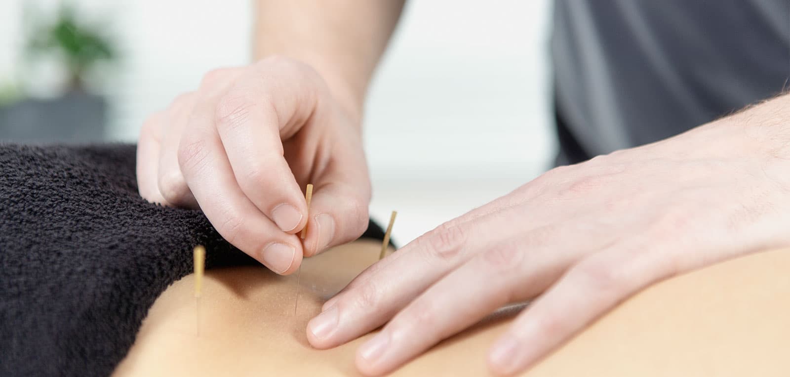 Dry needling